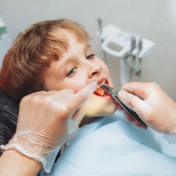 Dentist removing a child’s tooth