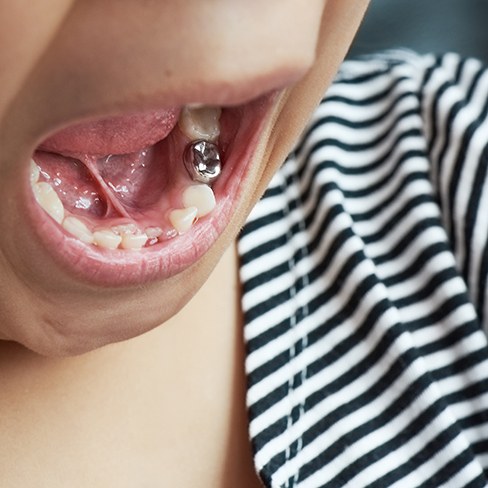 Stainless steel dental crown in a child’s mouth